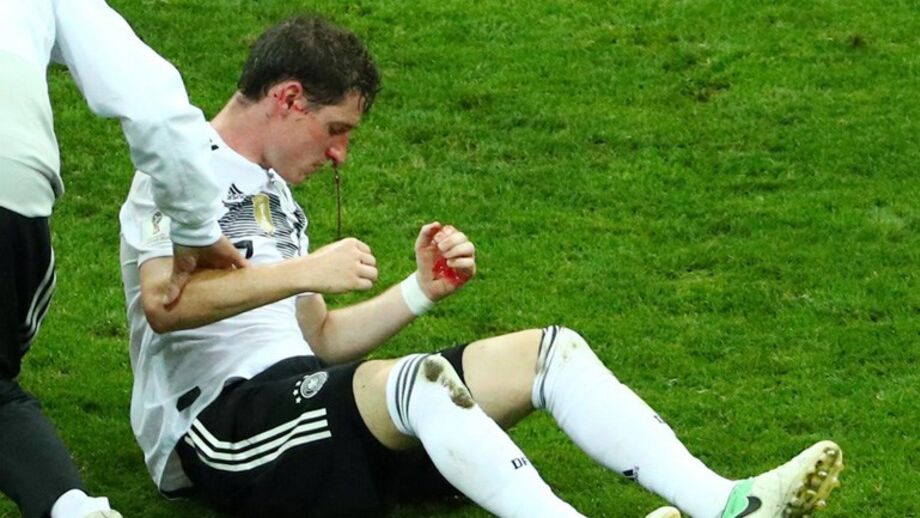 Impressionante: Rudy saiu em sangue do duelo da Alemanha