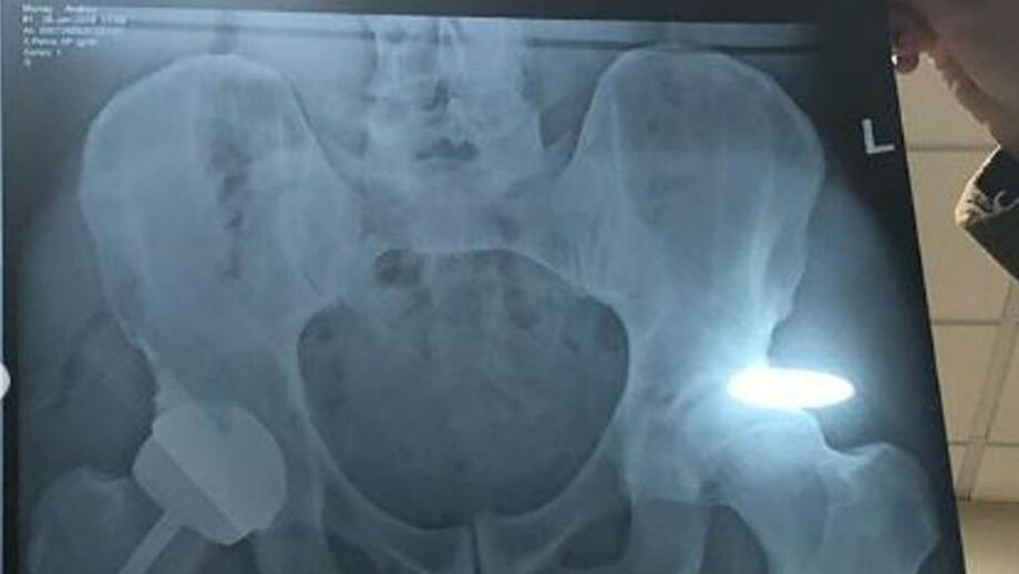 Raio-X de Murray revela mais do que o pretendido e torna-se viral