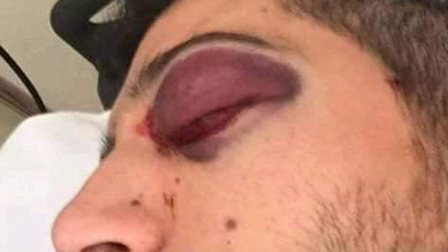 Hoquista do CF Carvalheiro arrisca perder visão