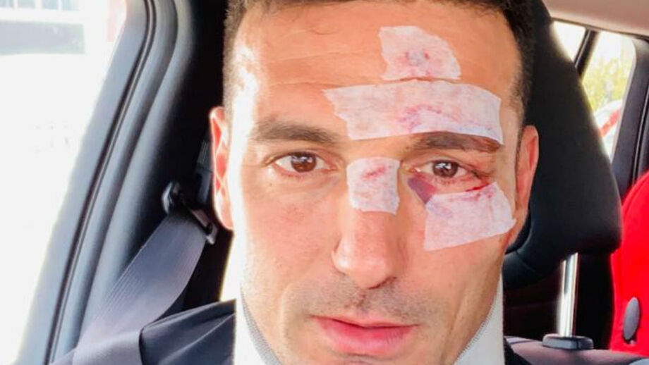 Scaloni já deixou o hospital: «Alguns pontos e casa»