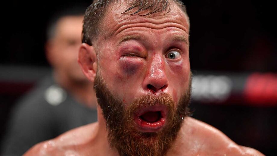 Impressionante: Lutador de UFC ficou com o olho neste estado após combate