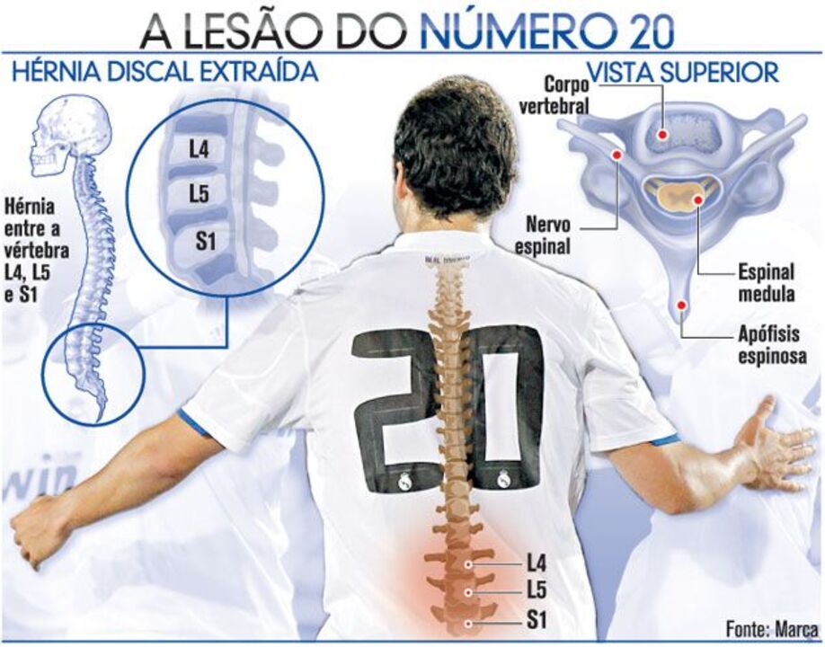 A lesão de Higuaín