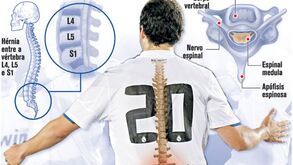 A lesão de Higuaín