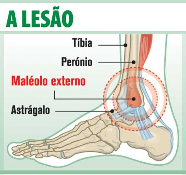 Lesão de Rinaudo ao pormenor