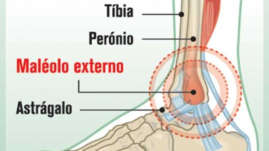 Lesão de Rinaudo ao pormenor