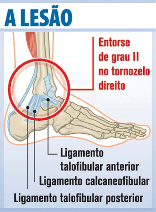 Entorse de Mangala à lupa