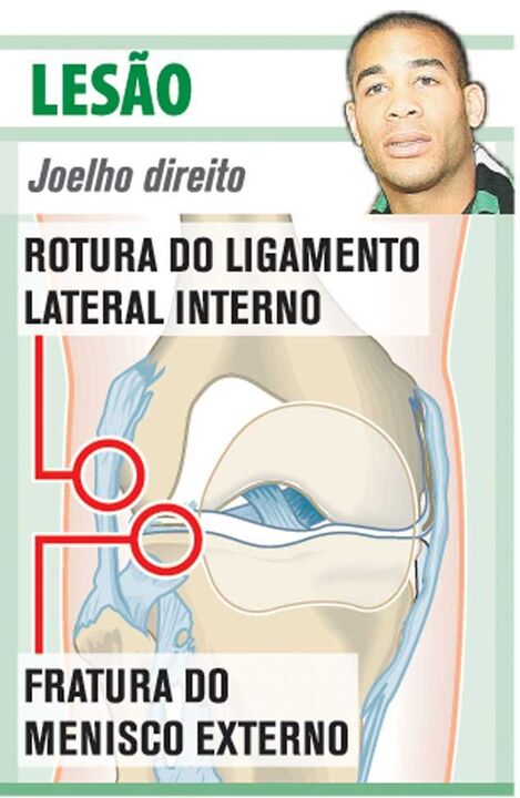 Lesão de Onyewu à lupa