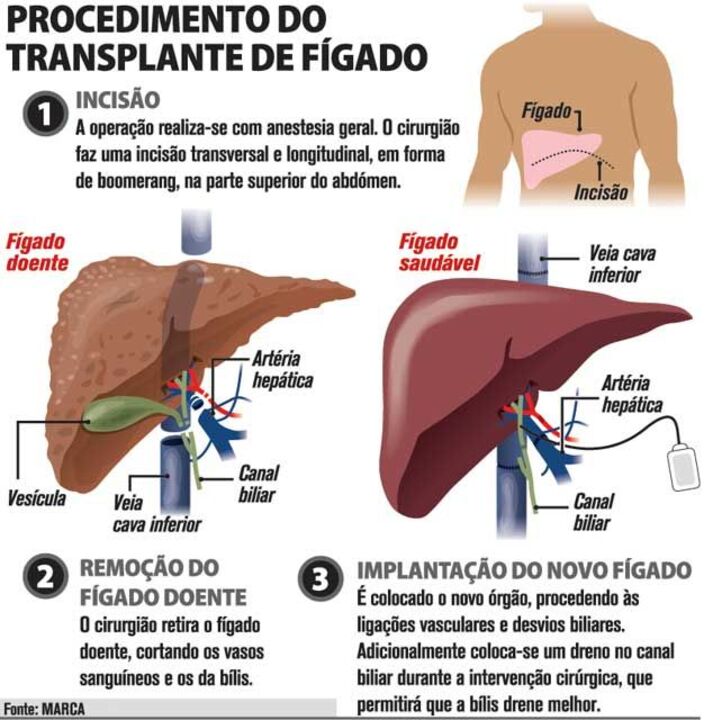 Transplante de fígado