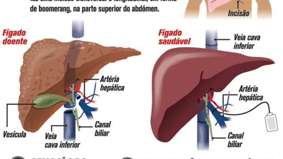 Transplante de fígado