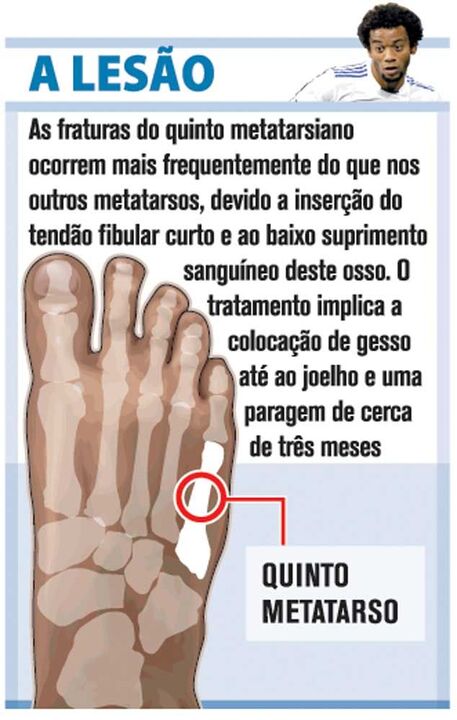 Lesão de Marcelo à lupa