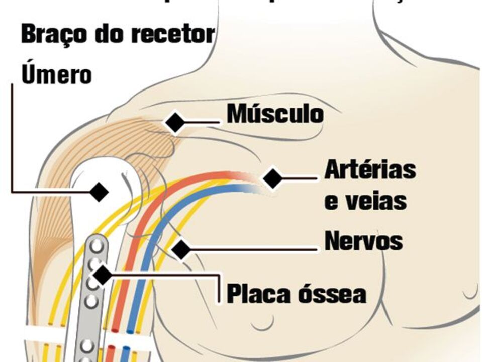 Militar submetido a raro transplante de braços