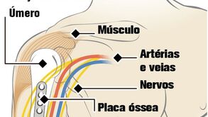 Militar submetido a raro transplante de braços