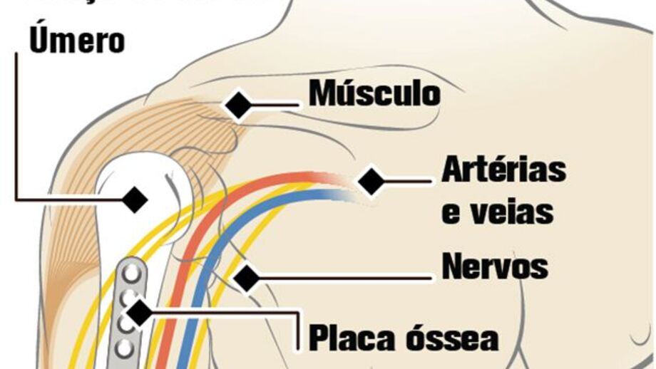 Militar submetido a raro transplante de braços
