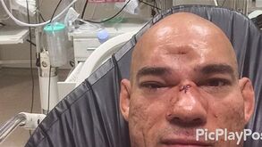 Veja o golpe que provocou a fratura de crânio a 'Cyborg' Santos