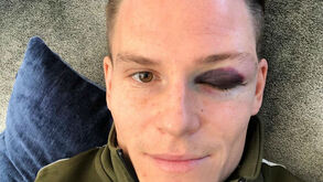 Kévin Gameiro mostra marca da 'guerra' em Camp Nou