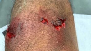 Varane ficou com joelho em estado... lastimável