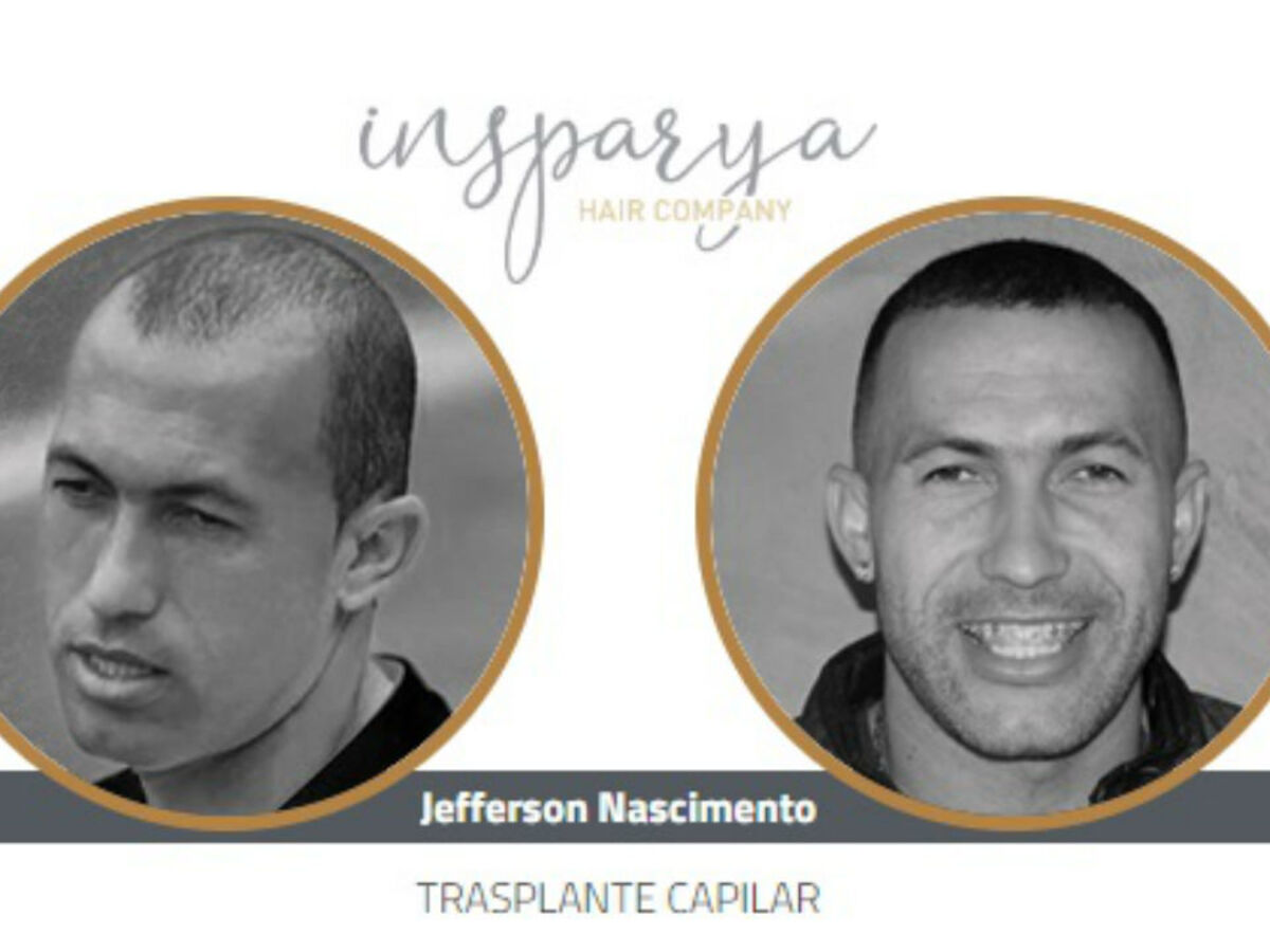 Famosos Do Desporto Nao Resistiram E Fizeram Implantes Capilares Na Clinica De Ronaldo Fotogalerias Jornal Record