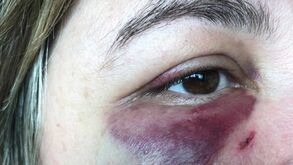 Mulher de dirigente do Sporting com marcas impressionantes após agressão no Dragão Caixa