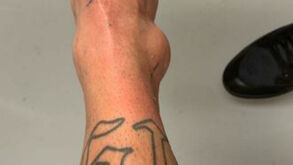 Assim ficou o tornozelo de Neymar