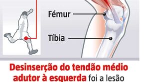 Lesão de Chiquinho à lupa: quando um tendão se solta do osso