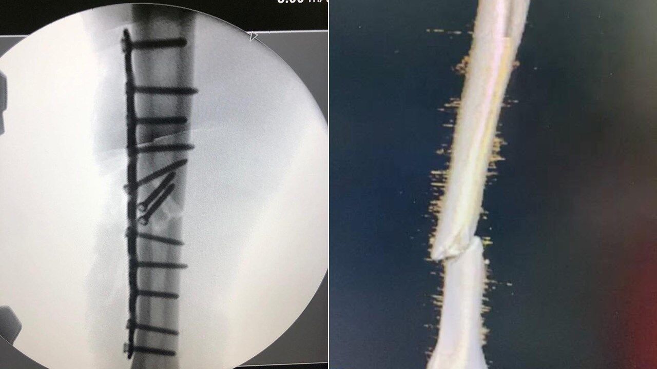 Márquez mostra o estado do seu braço 