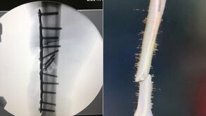 Marc Márquez com 13 parafusos no braço