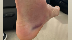 Assim ficou o tornozelo de Di María após a final da Copa América: imagens impressionam...