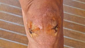 Ibrahimovic mostra como tinha o joelho há apenas três meses