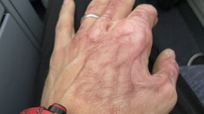 Grosjean revela que vai precisar de fazer um novo transplante de pele na mão esquerda