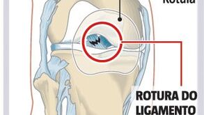 A lesão de Lucas Veríssimo à lupa