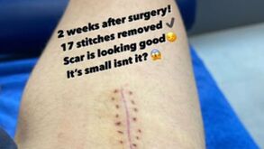 «Cicatriz pequena, não é»: Sergi Roberto mostra 'marca de guerra' após operação