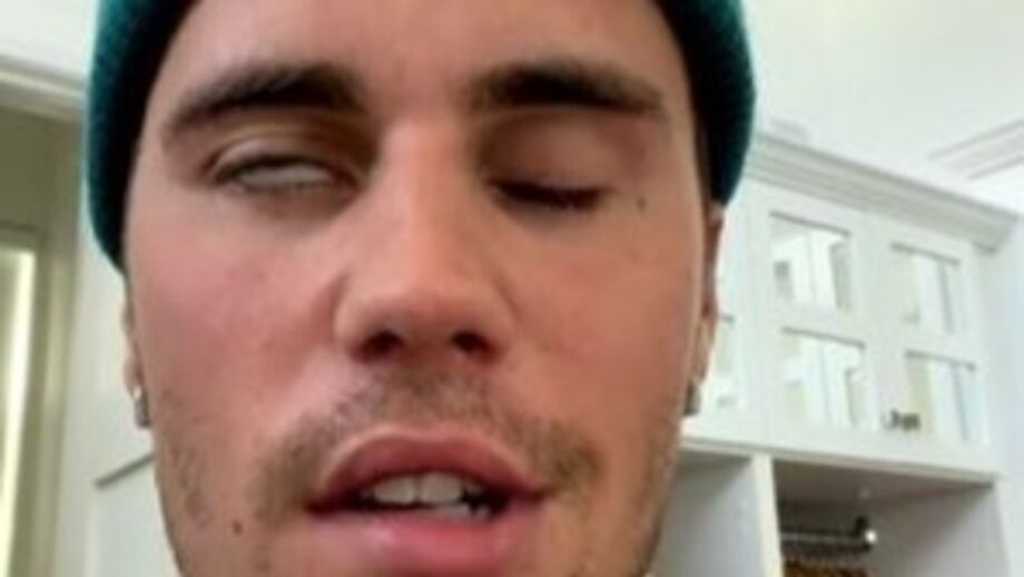 Justin Bieber aparece com metade do rosto paralisado e revela síndrome de Ramsay Hunt