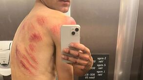 «Luta com tigres»: Rúben Guerreiro mostra marcas da queda sofrida no Tour