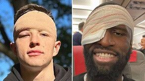 «Quase como novo»: guarda-redes do Shakhtar mostra mazelas do violento choque com Rüdiger