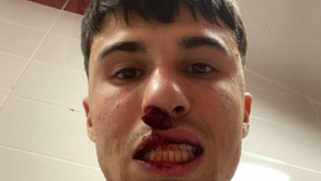 Incrível: Adepto do Sivasspor entrou em campo e partiu nariz a jogador da Fiorentina