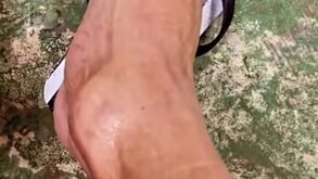 O impressionante estado em que ficou o tornozelo de Hulk após jogo: «Ossos do ofício» 