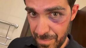 Alberto Contador sofreu violenta queda e ficou com a cara neste estado