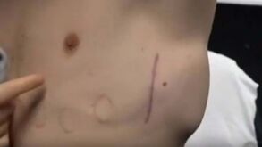 Capitão do Luton mostra desfibrilador que lhe foi implantado no peito: «Há um fio por aqui, que vai até ao coração...»
