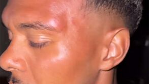 Assim ficou o rosto de defesa luso-alemão do Nuremberga após ter sido agredido por adeptos