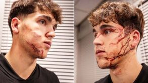 Muito sangue e sutura de 10 pontos: jogador do Barcelona sofreu lesão impressionante na cara