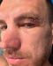 Edin Dzeko levou pontos na sobrancelha