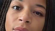 Jéssica Silva com lesão no olho