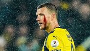 Edin Dzeko a sangrar do sobrolho