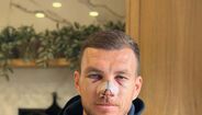 Edin Dzeko mostra mazelas