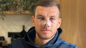 Dzeko é atingido com pontapé na cara e mostra marcas de guerra