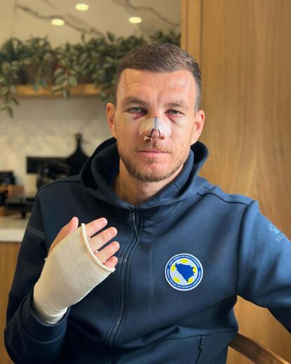 Edin Dzeko mostra mazelas