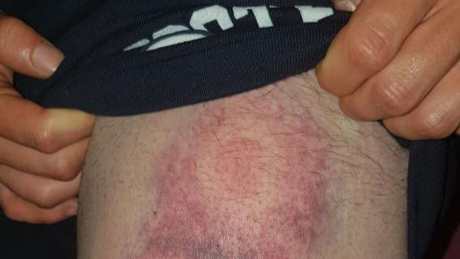 Adepto do Sporting mostra ferimentos na sequência de carga policial da festa do título