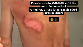 Ivo Oliveira sagrou-se campeão nacional depois de queda que lhe deixou as costas neste estado