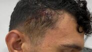 Tomás Araújo mostra corte na cabeça
