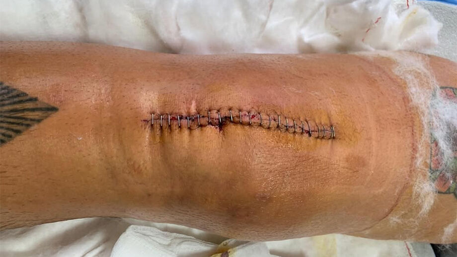 A imagem do joelho de Piccini após uma operação, que o próprio partilhou nas redes sociais